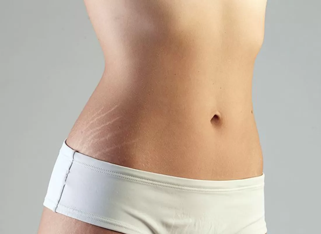 Stretch Mark Camouflage